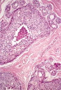 Papillotubular carcinoma