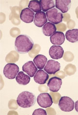 Acute lymphoid leukemia