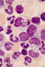 Chronic myeloid leukemia